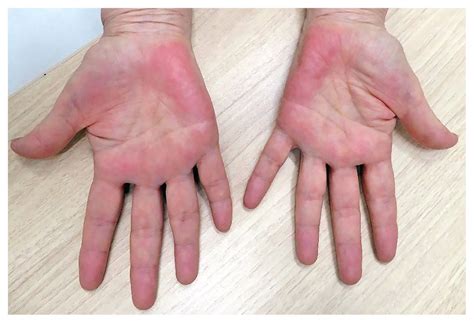 erythromelalgia pictures